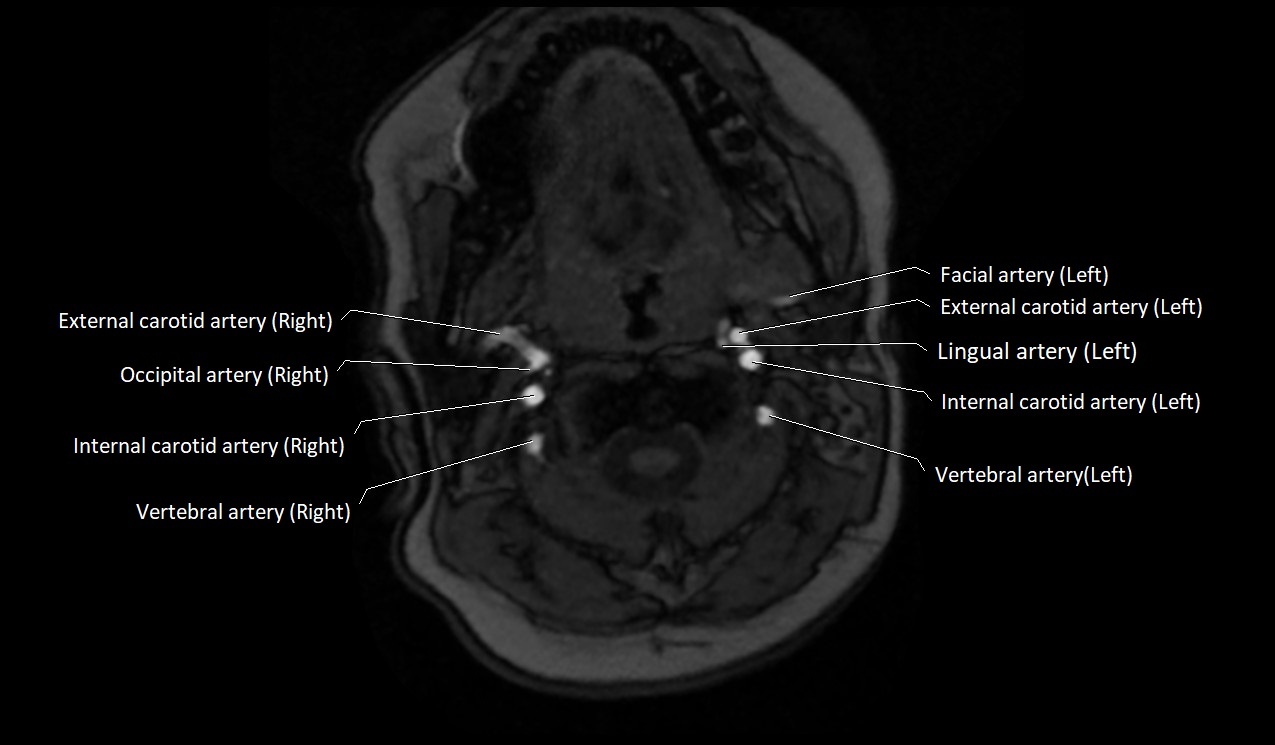 Carotid artery anatomy axial 3T image 18.jpg